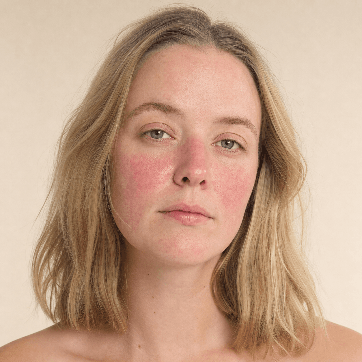 Rosacea and sleep: why tired skin may flush more
